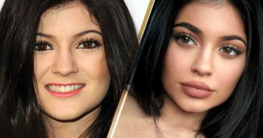 Натуральные губы Кайли и вместе с филлерами